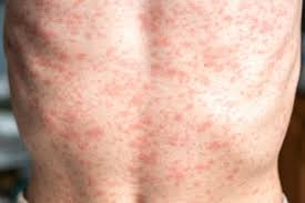 Measles case in taxes ; Measles patient receiving treatment in Texas hospital